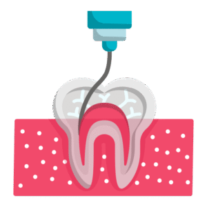 Root Canal Treatment: